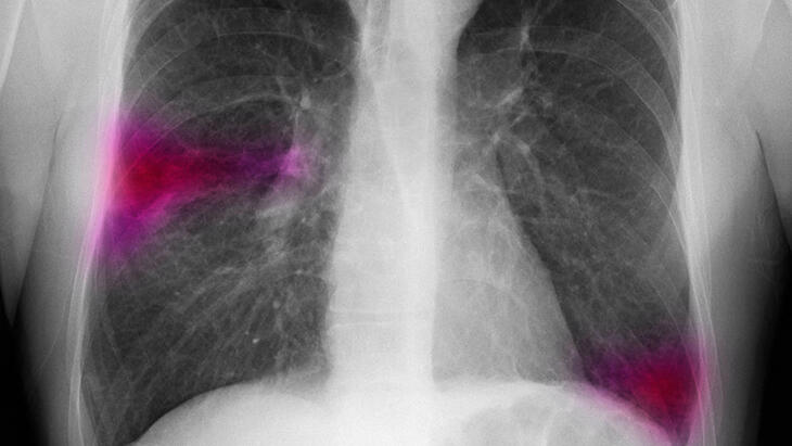 Pandemi sürecinde akciğer kanseri vakaları neden arttı?